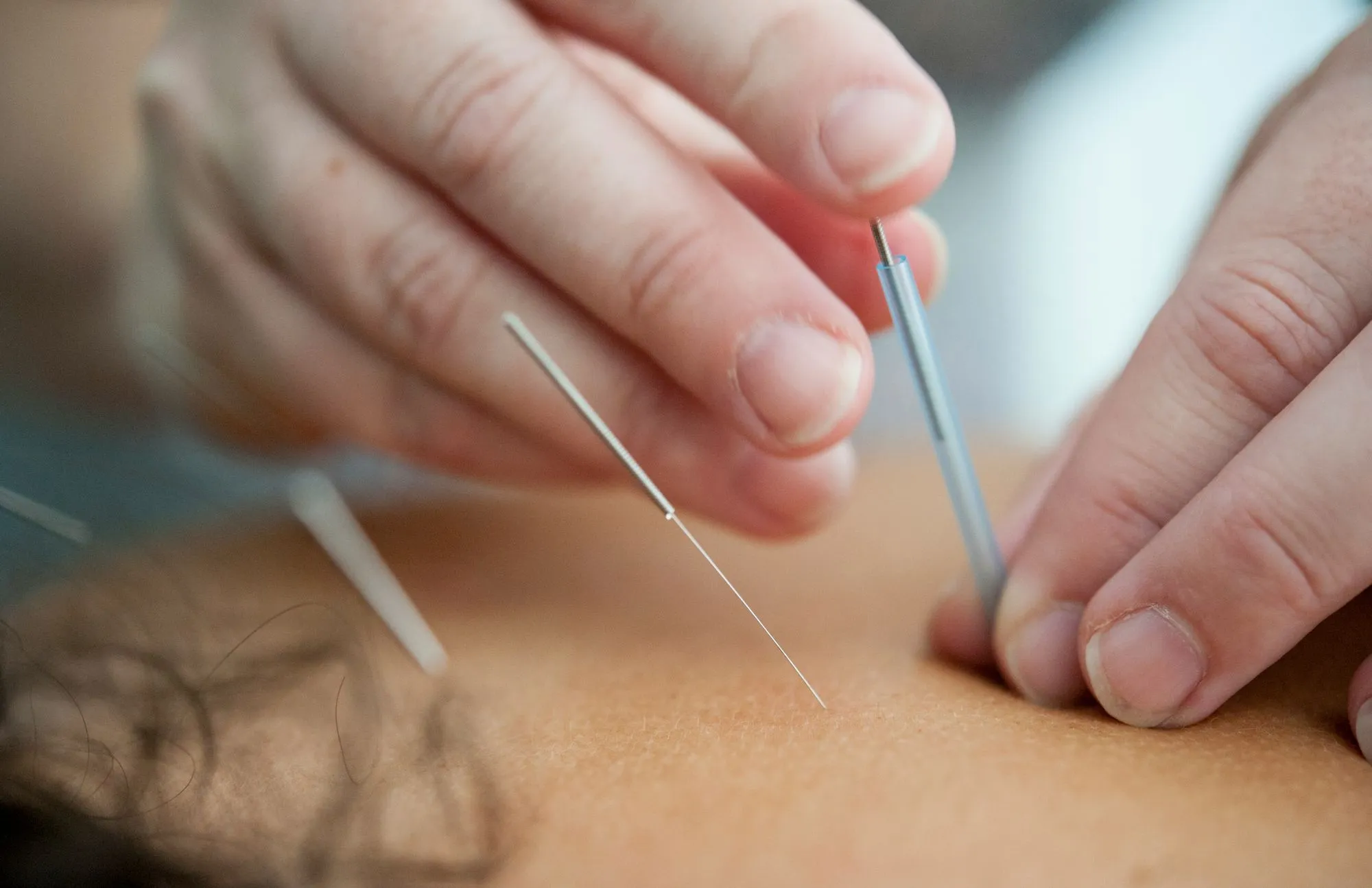 Acupuncture During Pregnancy